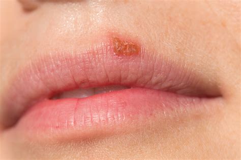 Oral Herpes Triggers Diagnosis Treatment