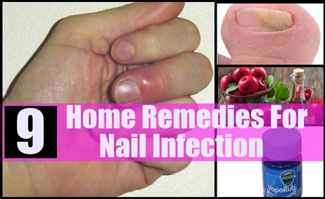 9 Home Remedies For Nail Infection Natural Treatments And Cure For Nail