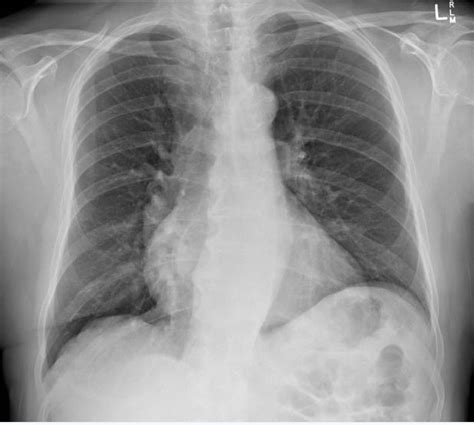 Mitral Stenosis Chest X Ray Wikidoc