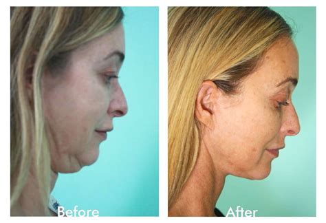 Plastic Surgery Tijuana, Mexico | Board-Certified Plastic Surgeons | VIDA