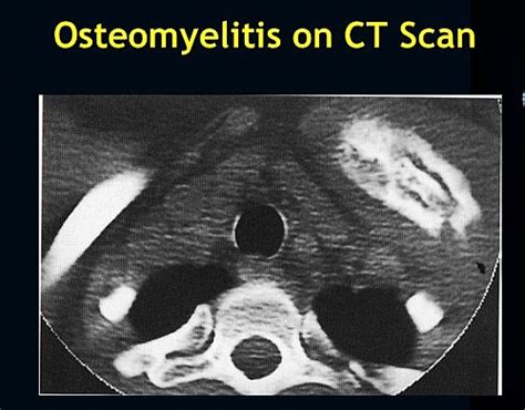 Osteomyelitis Bone Infection Symptoms Causes Treatment And