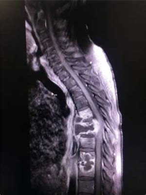 They affected more than 1 in 10. Tuberculosis - WikEM