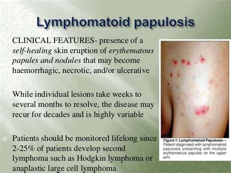 Image Result For Cutaneous Lymphomas Skin Eruptions Skin Healing Ulcers