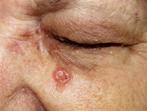 Basal Cell Carcinoma Clinical Presentation And Management Pcmed Project