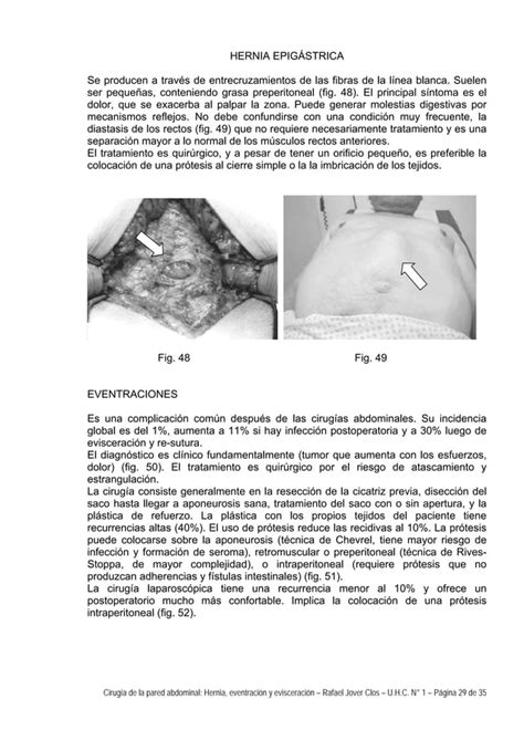 Cirugía De La Pared Abdominal Hernia Eventración Y Evisceración