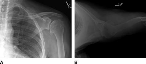Aaos Clinical Practice Guideline Management Of Glenohumeral Jaaos