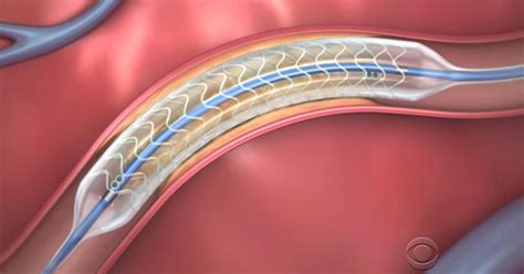 Us Surgeons Implant First Dissolvable Stent Cbs News