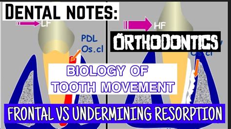 Frontal Vs Undermining Resorption Biology Of Tooth Movement Youtube