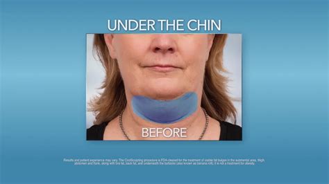 Freeze Your Double Chin Away With Coolsculpting Youtube