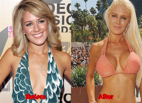 Heidi Montag Admitted To Have Undergone Plastic Surgery