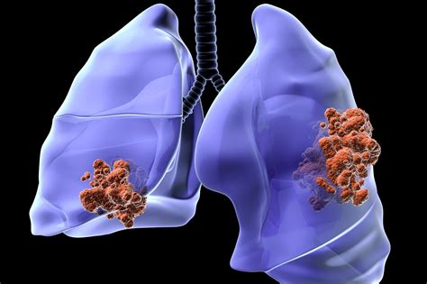 Les Différents Types Et Stades De Cancer Du Poumon Doctissimo