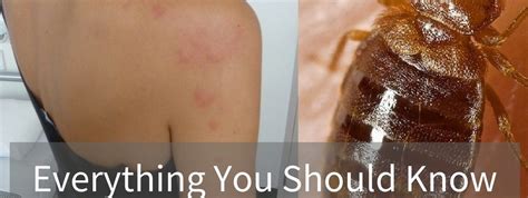 Bed Bugs 101 How Long Do Bed Bug Bites Last All You Should Know