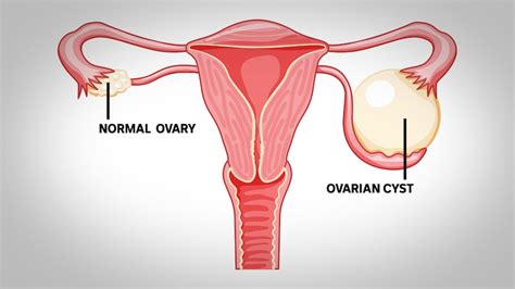 what s the deal with ovarian cysts breaking down the good the bad and the ugly abc news