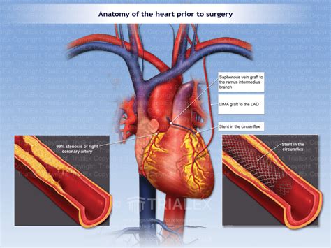 Anatomy Of The Heart Prior To Coronary Bypass Surgery Trialexhibits Inc