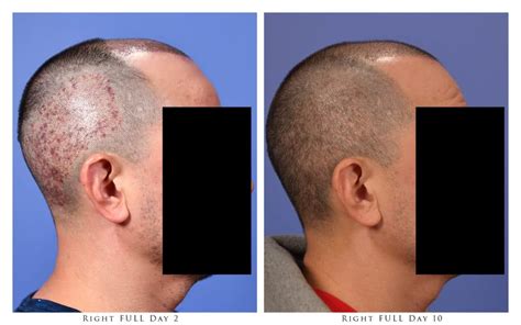 Fue Hair Transplant Timeline Day To Day Gabel Center