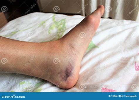 Swollen Leg After Ankle Sprain Stock Image 170079337