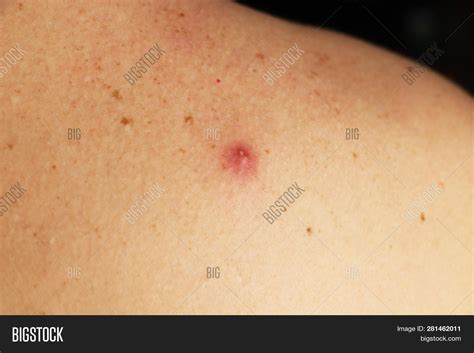 Photo Pimple Pus On Image And Photo Free Trial Bigstock