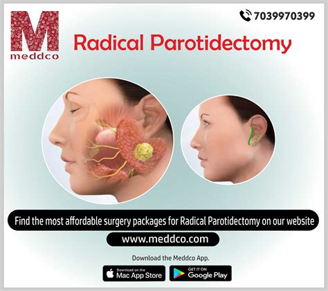 How To Prepare For The Surgery Of Radical Parotidectomy
