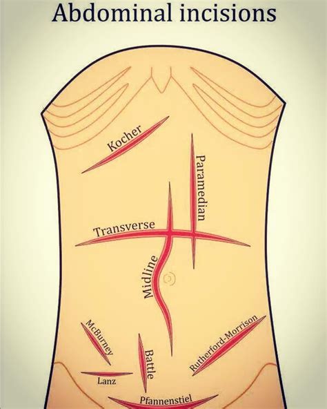 Abdominal Incisions In General Surger Abdominal Surgery General