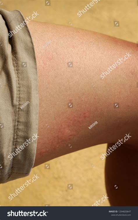 Rash On Legs Symptom Hives Skin Foto Stok 1294820647 Shutterstock