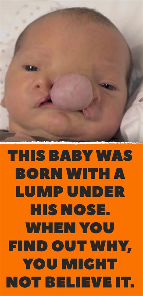 Successful Surgery For A Baby Born With A Tumor On His Face