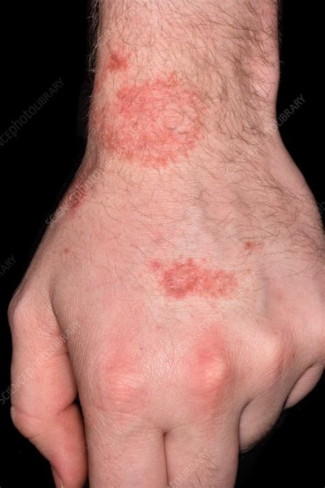 Contact Dermatitis Stock Image C0345322 Science Photo Library