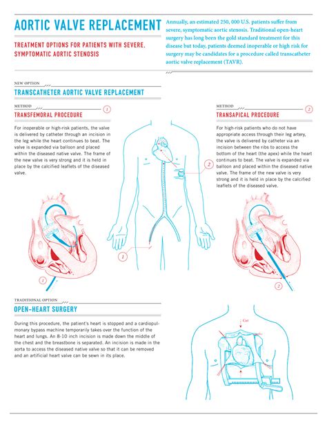 Infographic Aortic Valve Replacement Column Five