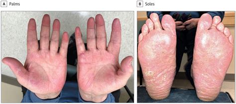 Topical Crisaborole—a Potential Treatment For Recalcitrant Palmoplantar