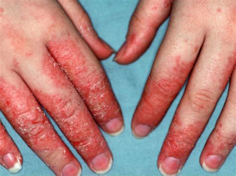 Eczemaatopic Dermatitis Mclean And Woodbridge Va
