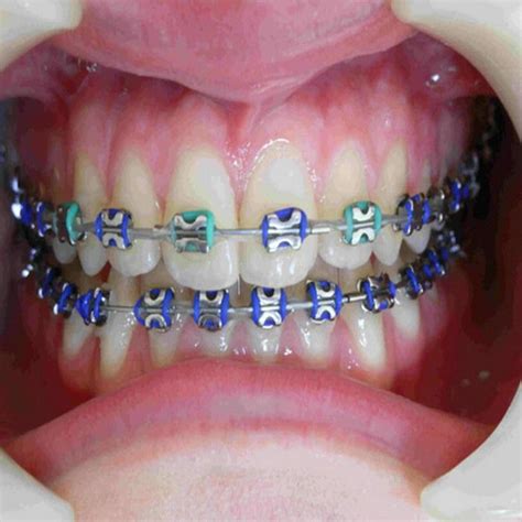 It will then tell you which color braces would be perfect for you! Color Orthodontic Braces | Braces colors, Dental braces