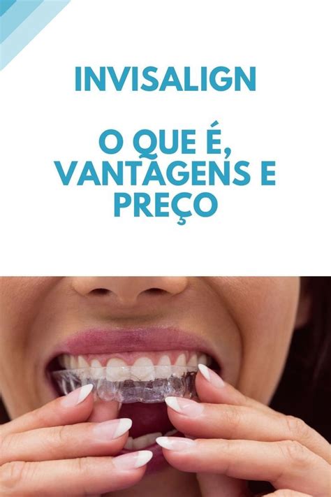 Invisalign O Que Vantagens E Pre O Tratamento Odontologico