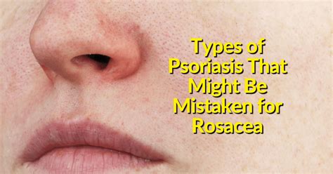 Psoriasis Vs Rosacea Differences Treatment And Other Conditions