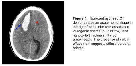 American Thoracic Society Intracerebral Hemorrhage In A Young Adult