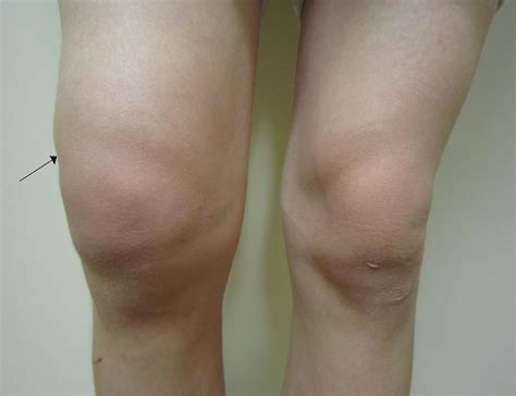 Derrame Articular Tibiotalar Tornozelo