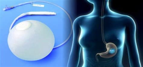 Safe And Effective Gastric Balloon Treatment Obesity Solutions