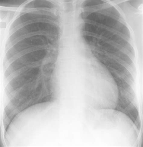 PLAIN RADIOGRAPHIC DIAGNOSIS OF CONGENITAL HEART DISEASE