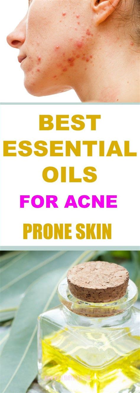 Best Essential Oils For Acne Prone Skin Skin Care Acne Essential Oil