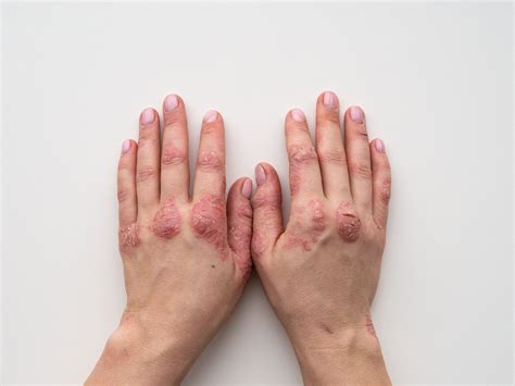 Psoriasis Awareness Month — Advanced Dermatology And Aesthetic Medicine
