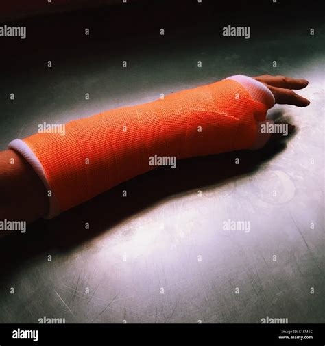 A Picture Of A Female Forearm In An Orange Cast On Top Of A Metal