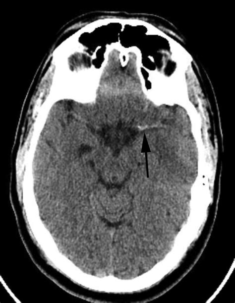Modern Neuroimaging Techniques In Diagnosing Transient Ischemic Attack