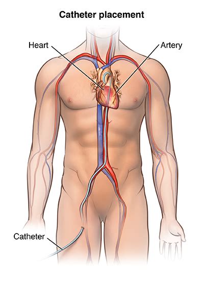 Angioplasty And Stent Placement For The Heart Health Encyclopedia