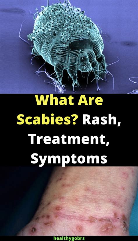 What Is Scabies Everything You Need To Know About Sca Vrogue Co