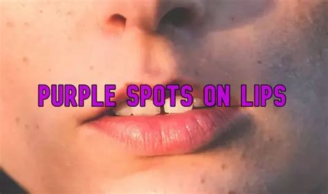 Purple Spot On Lips Causes Signs And Treatment Health Advisor