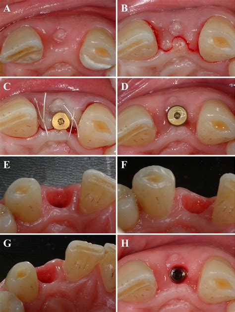 Figure 2 From M Flap Design For Promoting Implant Esthetics