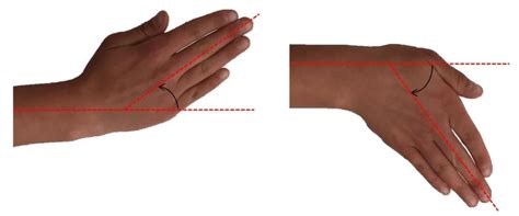 14 Range Of Wrist Motion Radial Ulnar Deviation Wrist Joint Motion