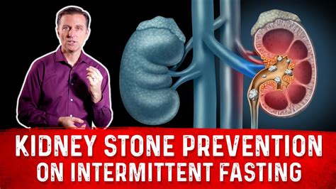 How To Prevent Kidney Stones On Intermittent Fasting If You Are