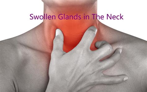 Swollen Glands In Neck 8 Common Causes With Treatment 2022