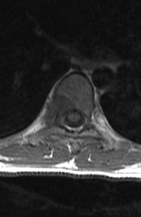 Osteoid Osteoma Of The Spine Image