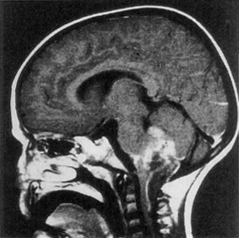 Surgical Management Of Brain Stem Tumors In Children Results And