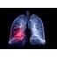 Lung Cancer Screening Explained By A Pulmonologist